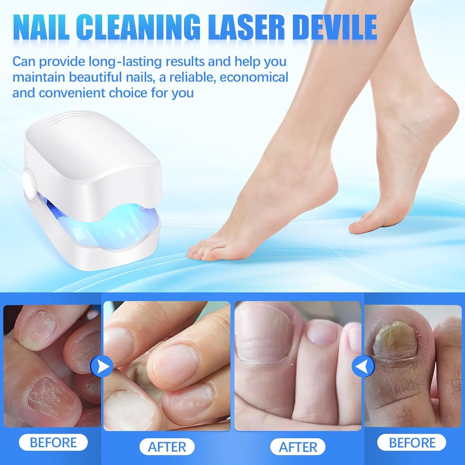 Nail Fungus Laser Treatment – Rechargeable Device for Hands & Feet | AuriGlam