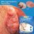 Skin Tag Remover Kit 2-in-1 – Painless Home Use | Arrive Kit