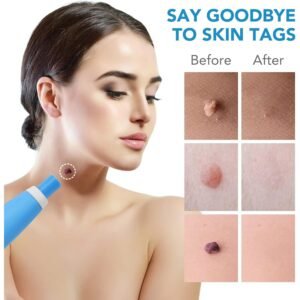 Skin Tag Remover Kit 2-in-1 – Painless Home Use | Arrive Kit