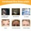 Forehead Wrinkle Patches (10 Pcs) – Anti-Aging Pads | GlowForm